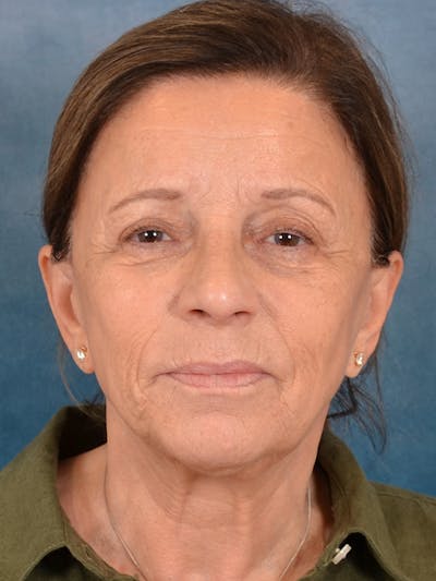 Laser Skin Resurfacing Before & After Gallery - Patient 104537 - Image 1