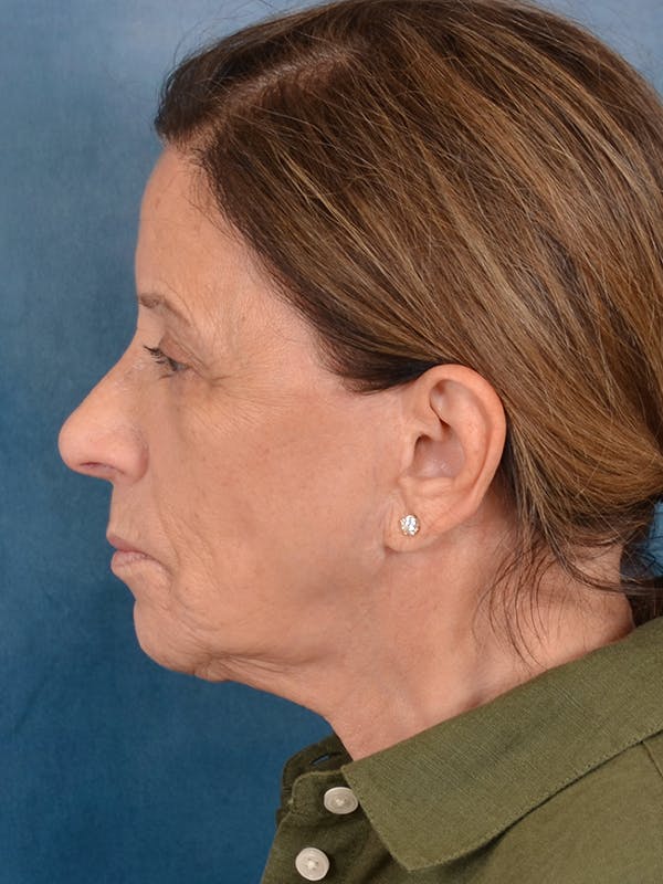 Laser Skin Resurfacing Before & After Gallery - Patient 104537 - Image 5