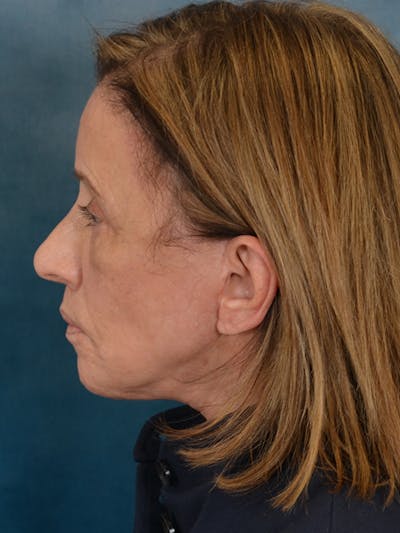 Laser Skin Resurfacing Before & After Gallery - Patient 104537 - Image 6