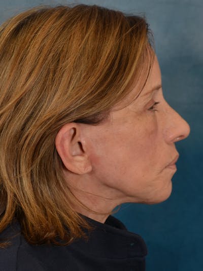 Laser Skin Resurfacing Before & After Gallery - Patient 104537 - Image 8