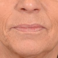 Lip Lift Before & After Gallery - Patient 238975 - Image 1