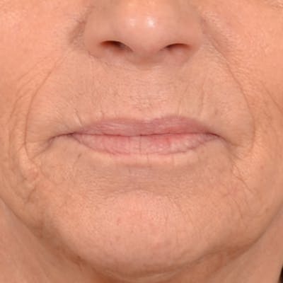 Lip Lift Before & After Gallery - Patient 238975 - Image 1