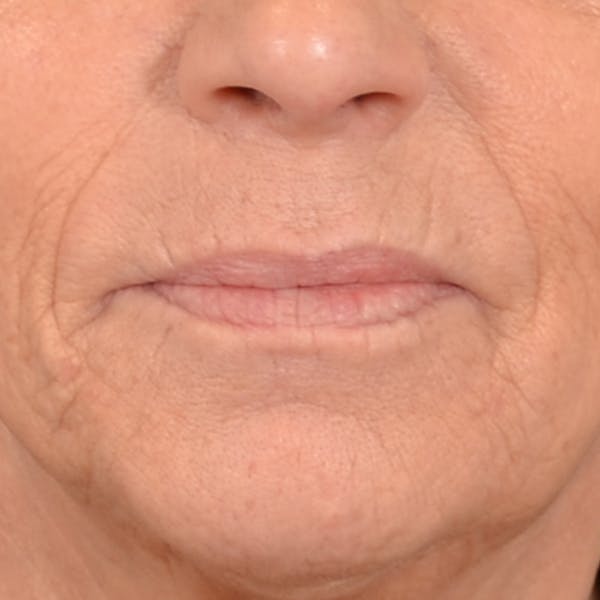 Lip Lift Before & After Gallery - Patient 238975 - Image 1