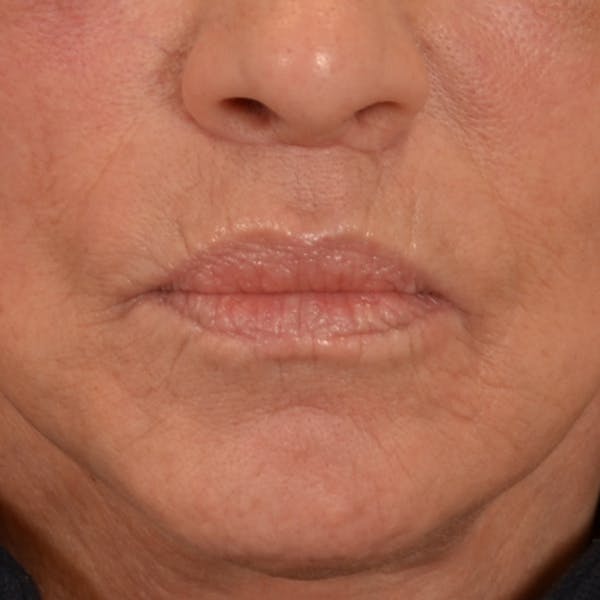 Lip Lift Before & After Gallery - Patient 238975 - Image 2