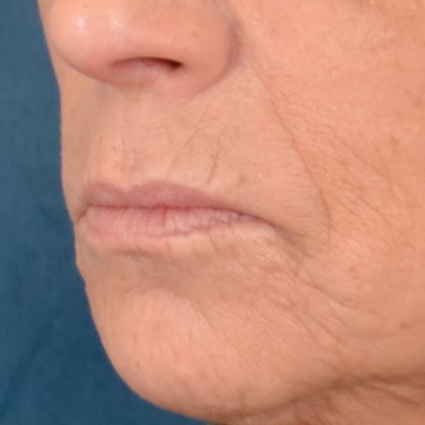 Lip Lift Before & After Gallery - Patient 238975 - Image 3