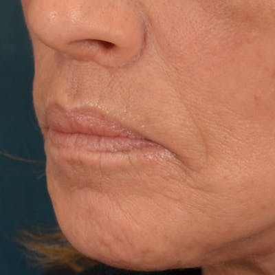 Lip Lift Before & After Gallery - Patient 238975 - Image 4