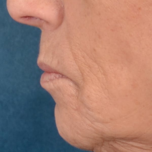 Lip Lift Before & After Gallery - Patient 238975 - Image 5