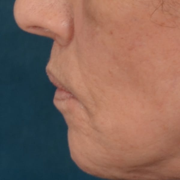 Lip Lift Before & After Gallery - Patient 238975 - Image 6