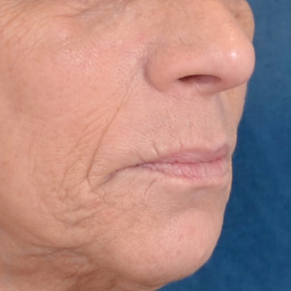 Lip Lift Before & After Gallery - Patient 238975 - Image 9