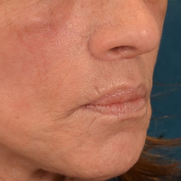 Lip Lift Before & After Gallery - Patient 238975 - Image 8