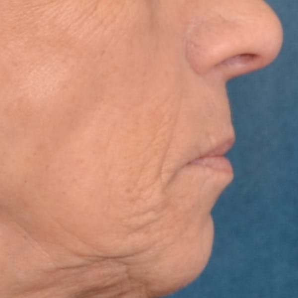 Lip Lift Before & After Gallery - Patient 238975 - Image 7