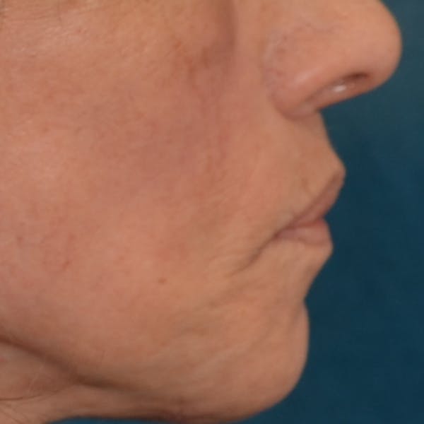 Lip Lift Before & After Gallery - Patient 238975 - Image 10