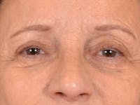 Eyelid Lift Before & After Gallery - Patient 682596 - Image 1