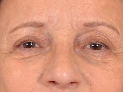Eyelid Lift Before & After Gallery - Patient 682596 - Image 1