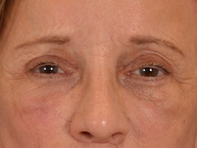Eyelid Lift Before & After Gallery - Patient 682596 - Image 2