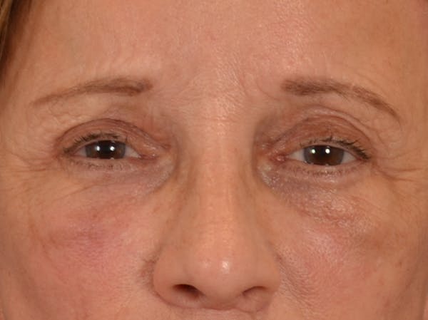 Eyelid Lift Before & After Gallery - Patient 682596 - Image 2