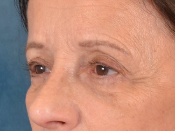 Eyelid Lift Before & After Gallery - Patient 682596 - Image 3