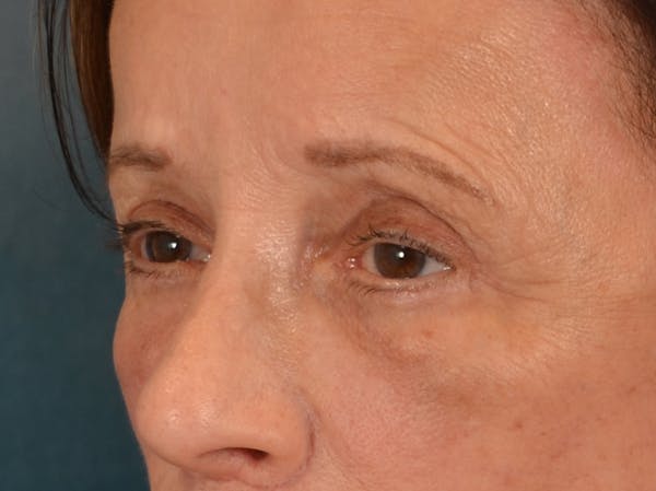 Eyelid Lift Before & After Gallery - Patient 682596 - Image 4