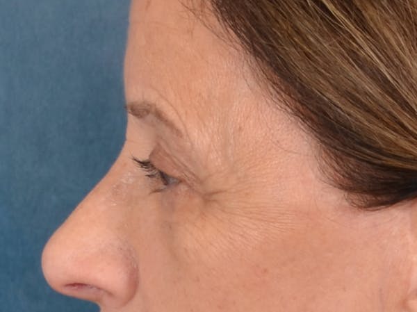 Eyelid Lift Before & After Gallery - Patient 682596 - Image 5