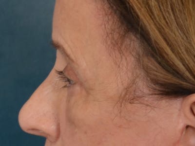 Eyelid Lift Before & After Gallery - Patient 682596 - Image 6