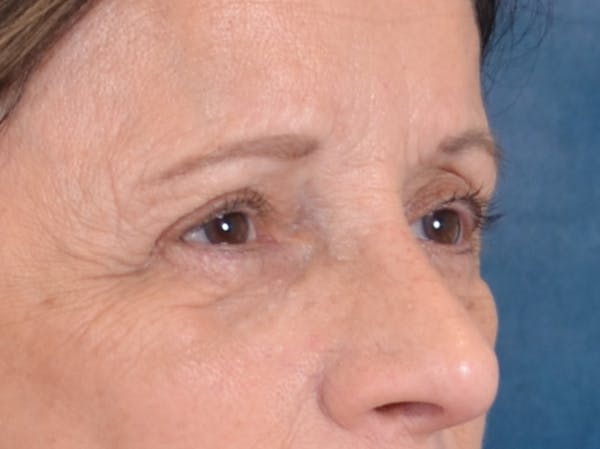 Eyelid Lift Before & After Gallery - Patient 682596 - Image 9