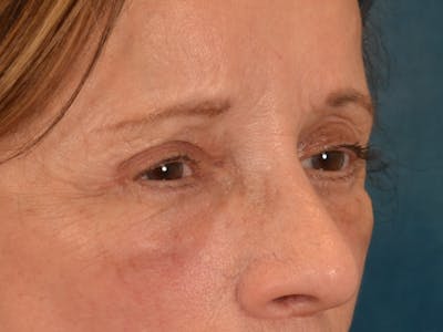 Eyelid Lift Before & After Gallery - Patient 682596 - Image 10
