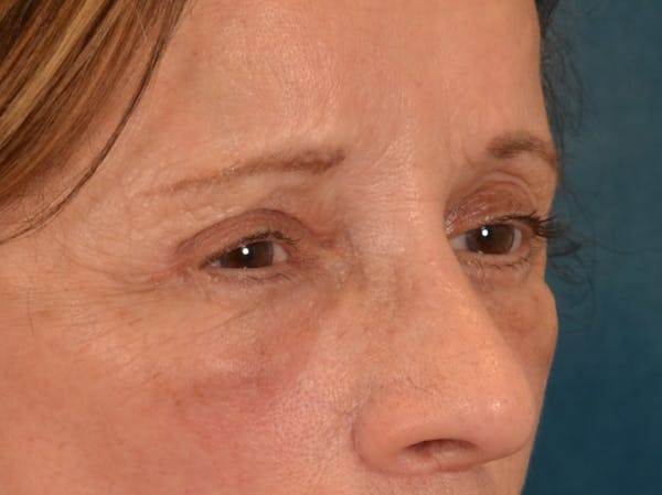 Eyelid Lift Before & After Gallery - Patient 682596 - Image 10