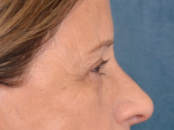 Eyelid Lift Before & After Gallery - Patient 682596 - Image 7