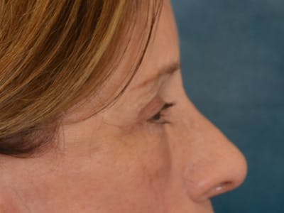 Eyelid Lift Before & After Gallery - Patient 682596 - Image 8