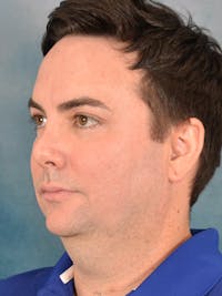 Deep Plane Facelift Before & After Gallery - Patient 305079 - Image 1