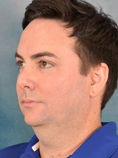 Deep Plane Facelift Before & After Gallery - Patient 305079 - Image 1