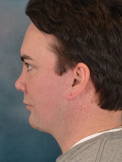 Revision Rhinoplasty Before & After Gallery - Patient 270222 - Image 2
