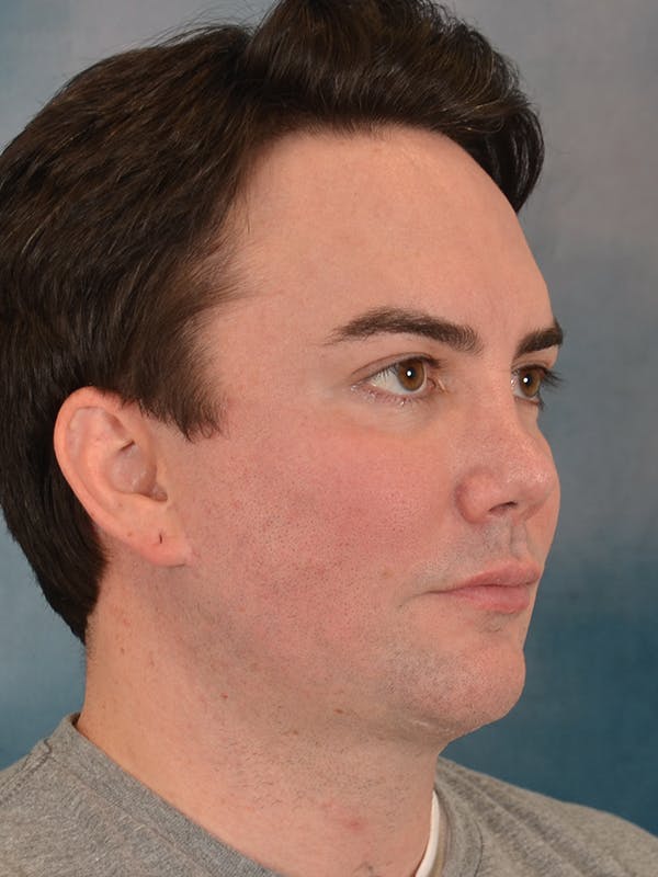 Chin Augmentation Before & After Gallery - Patient 346886 - Image 10