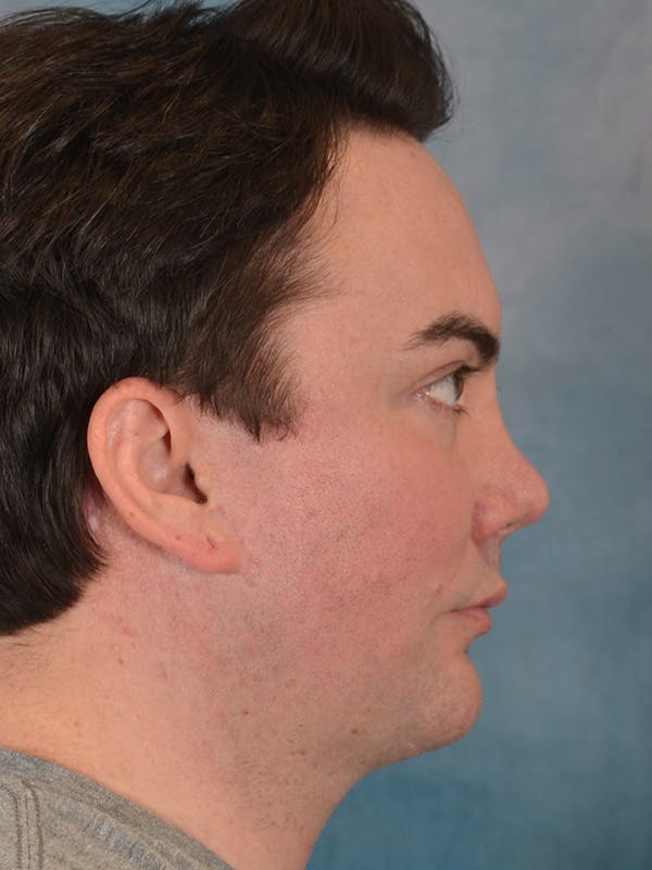 Chin Augmentation Before & After Gallery - Patient 346886 - Image 8
