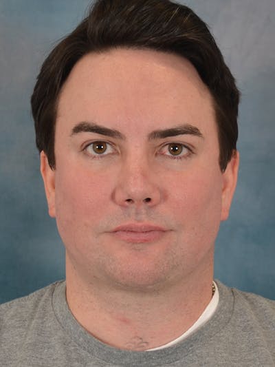 Chin Augmentation Before & After Gallery - Patient 346886 - Image 2