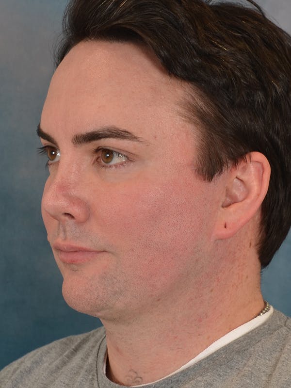 Chin Augmentation Before & After Gallery - Patient 346886 - Image 4