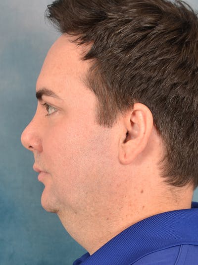 Revision Rhinoplasty Before & After Gallery - Patient 270222 - Image 1