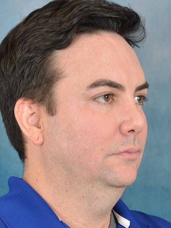 Chin Augmentation Before & After Gallery - Patient 346886 - Image 9
