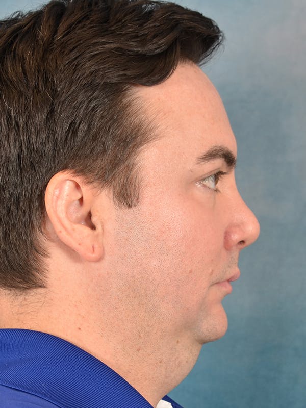 Chin Augmentation Before & After Gallery - Patient 346886 - Image 7
