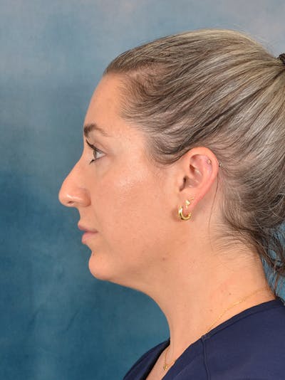 Rhinoplasty Before & After Gallery - Patient 365787 - Image 1