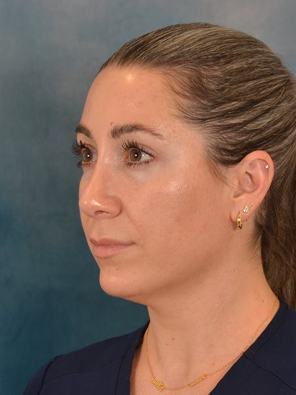 Rhinoplasty Before & After Gallery - Patient 365787 - Image 4