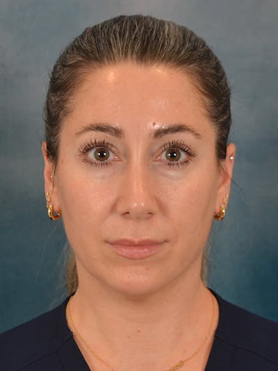 Rhinoplasty Before & After Gallery - Patient 365787 - Image 6