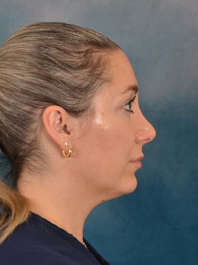 Rhinoplasty Before & After Gallery - Patient 365787 - Image 10