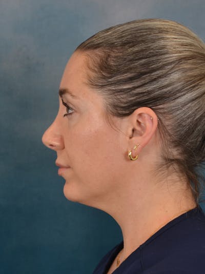 Rhinoplasty Before & After Gallery - Patient 365787 - Image 2