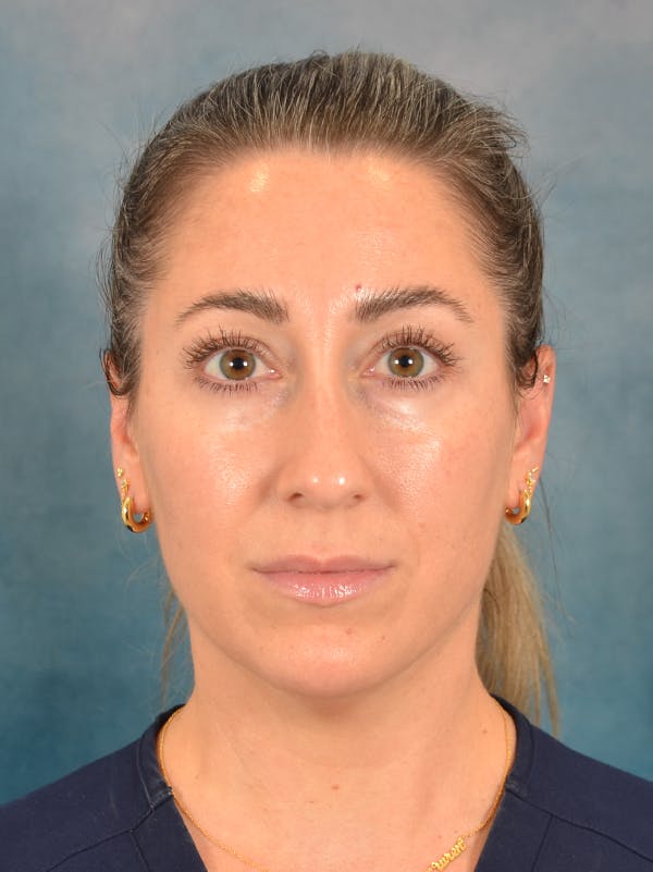 Rhinoplasty Before & After Gallery - Patient 365787 - Image 5