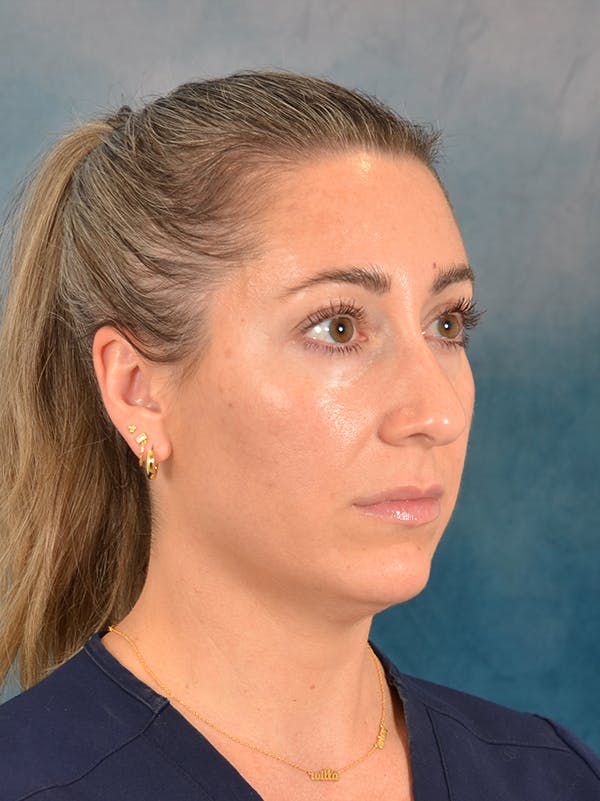 Rhinoplasty Before & After Gallery - Patient 365787 - Image 7
