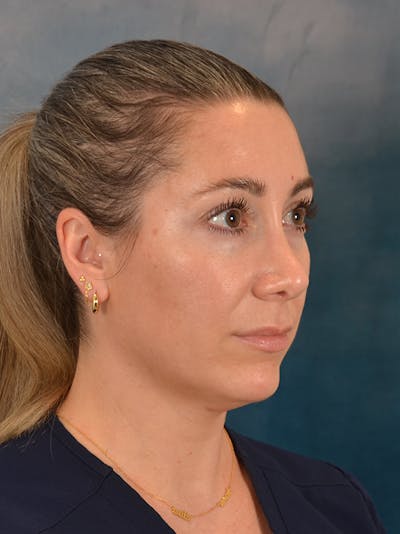 Rhinoplasty Before & After Gallery - Patient 365787 - Image 8