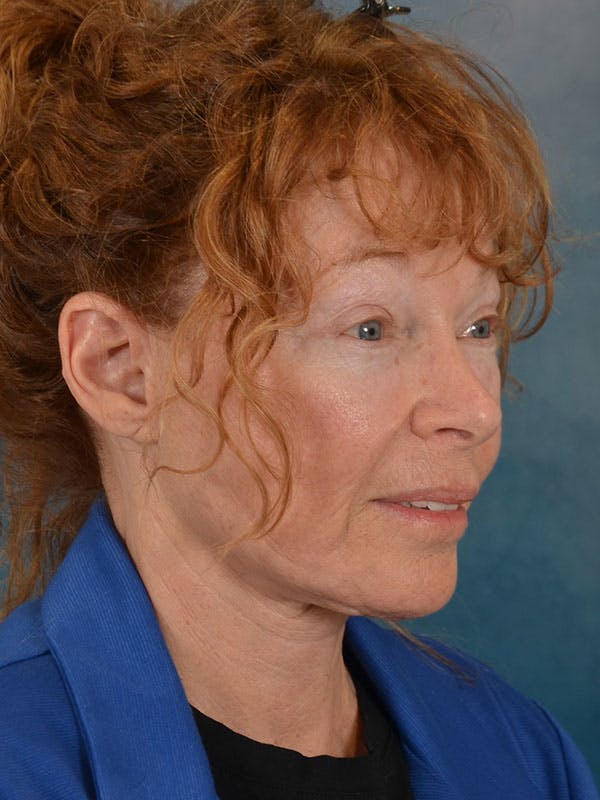 Brow Lift Before & After Gallery - Patient 306928 - Image 10