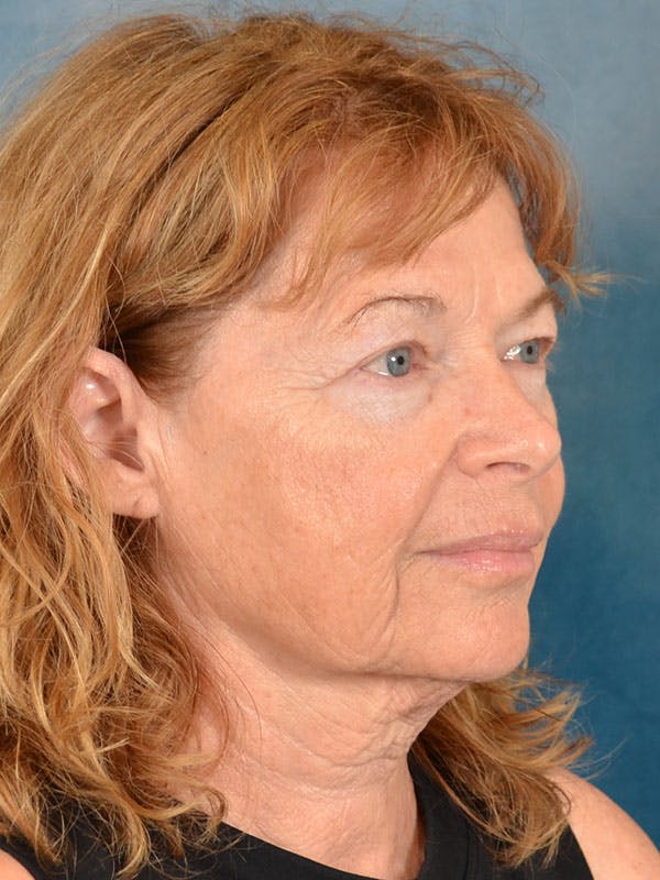 Brow Lift Before & After Gallery - Patient 306928 - Image 9