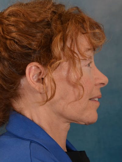 Brow Lift Before & After Gallery - Patient 306928 - Image 8